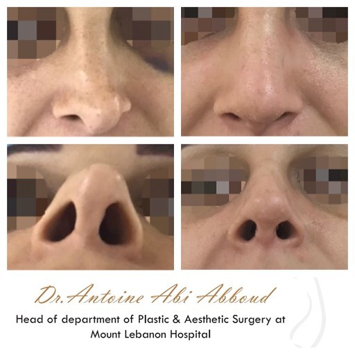 Nose Surgery before and after — case 3