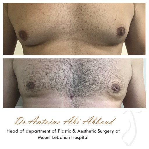 Gynecomastia before and after — case 3