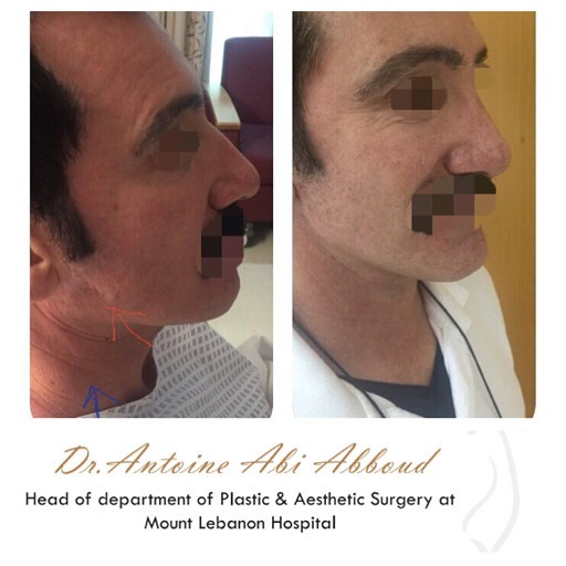 Face & Neck Lift before and after — case 2
