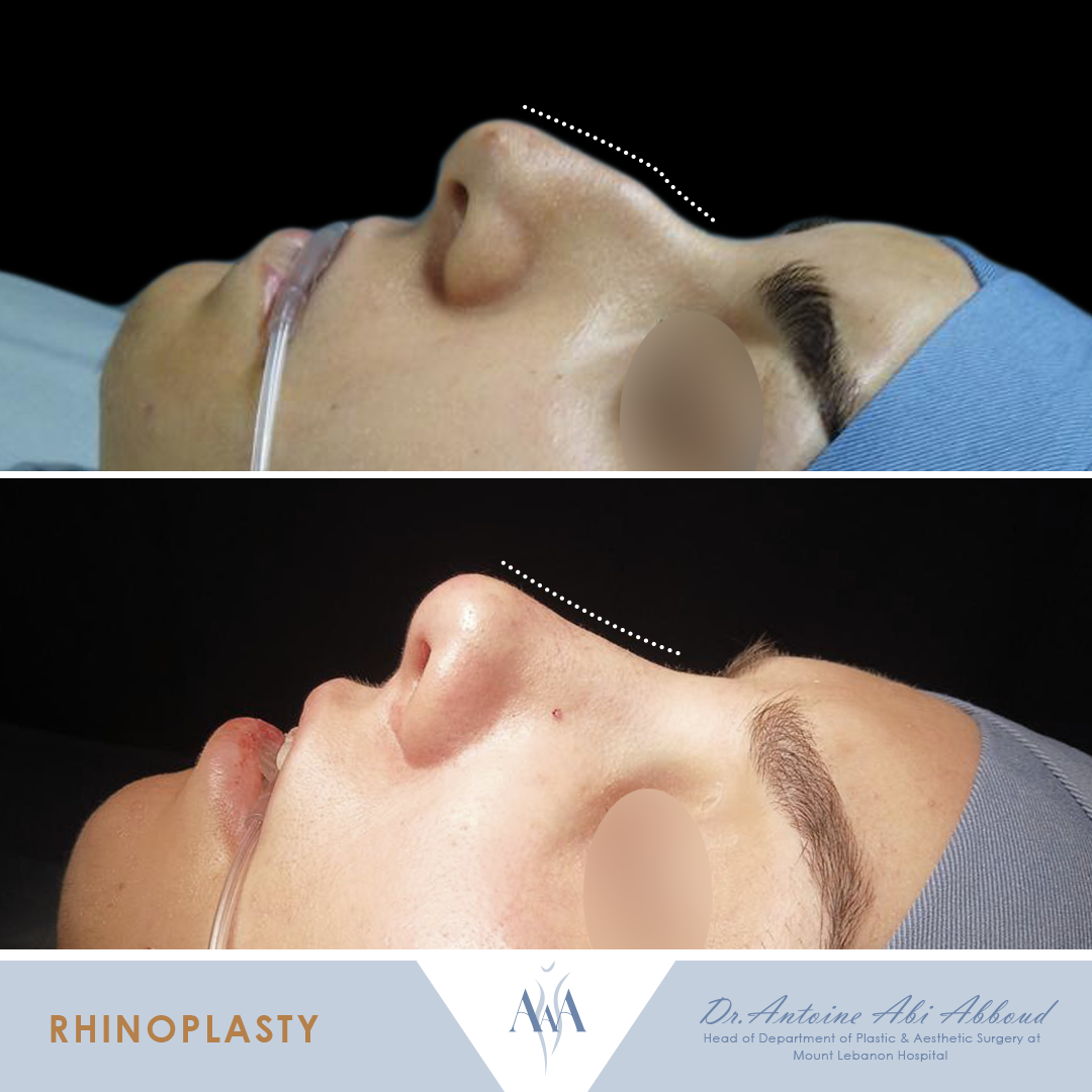 Nose Surgery before and after — case 7
