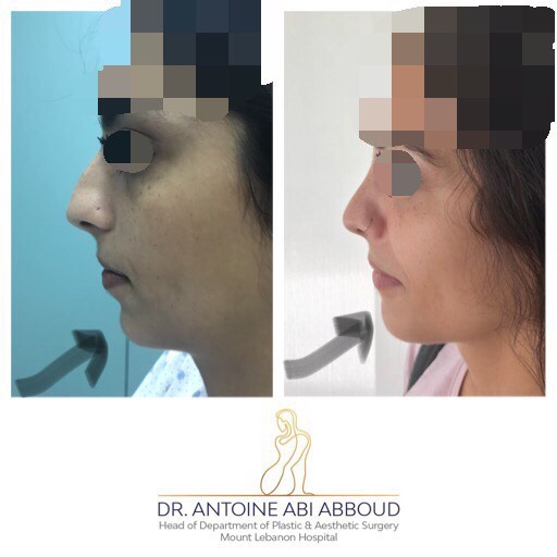 Chin Surgery before and after — case 1