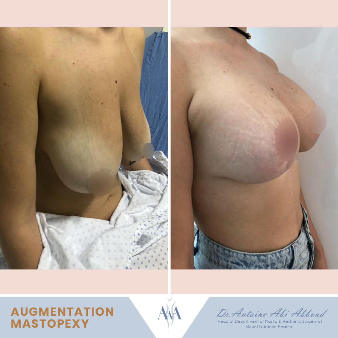 Mastopexy (Breast Lift) before and after — case 6