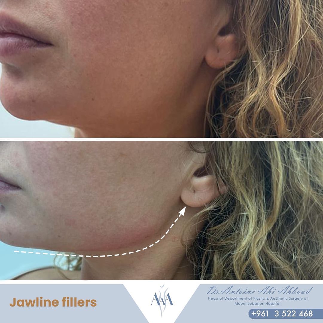 Fillers before and after — case 1