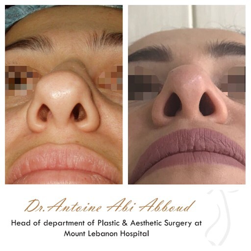 Nose Surgery before and after — case 4