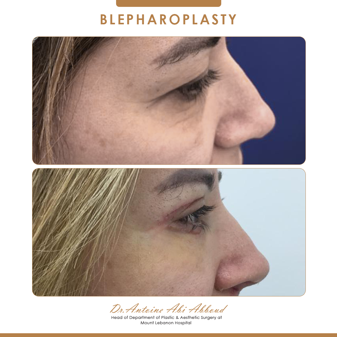 Blepharoplasty before and after — case 7