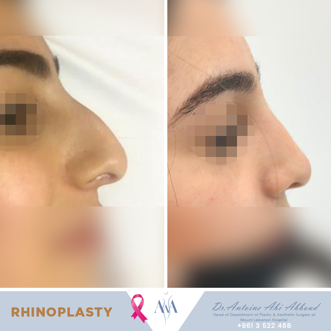 Nose Surgery before and after — case 8