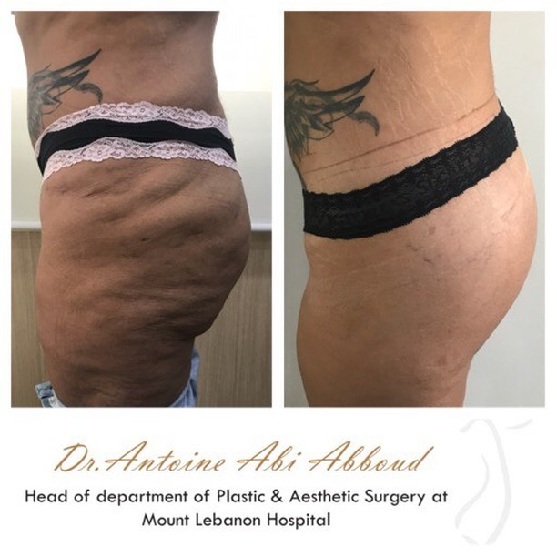 Butt Lift before and after — case 1