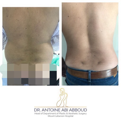 Liposuction before and after — case 5
