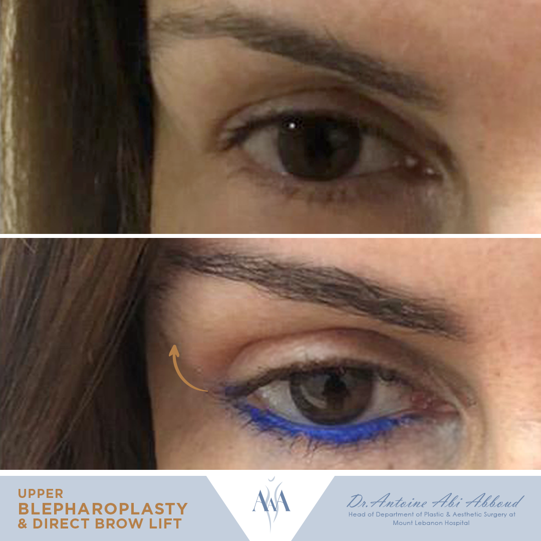 Brow Lift before and after — case 4