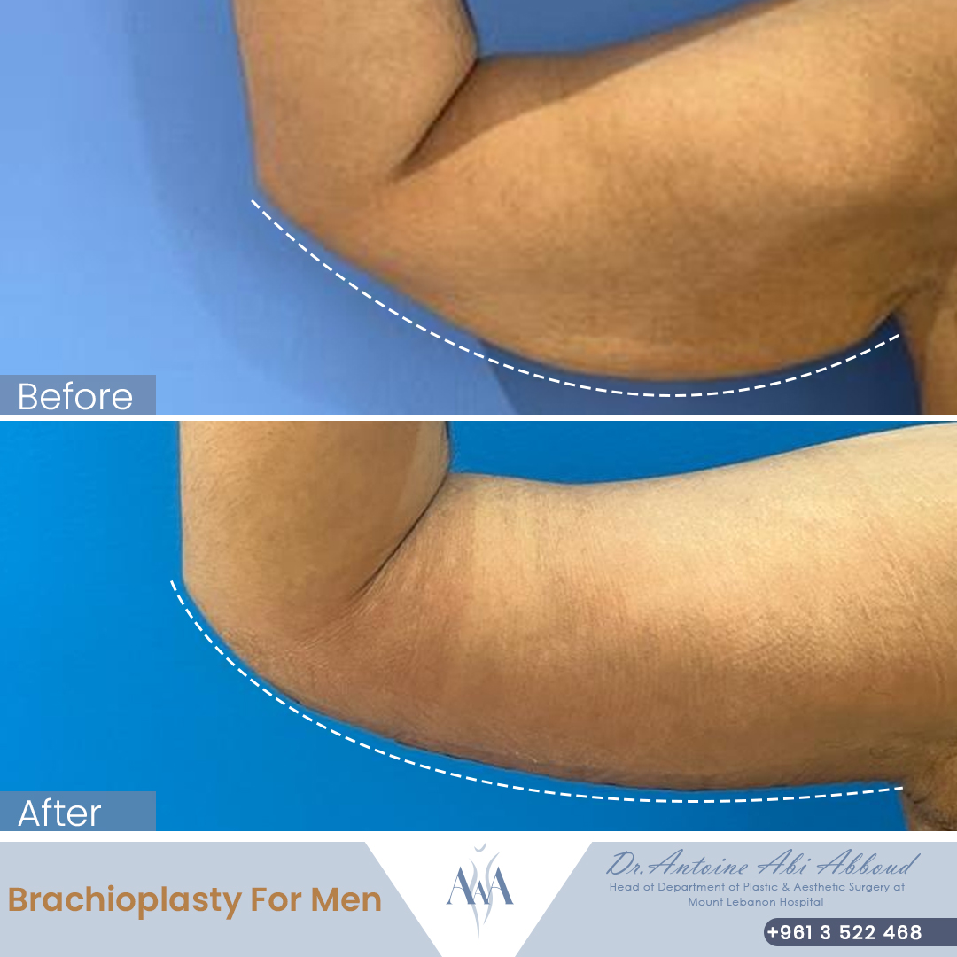 Arm Lift before and after — case 5