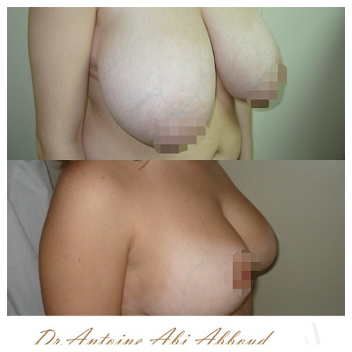 Breast Reduction before and after — case 1