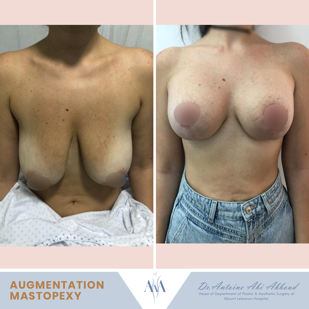 Mastopexy (Breast Lift) before and after — case 7
