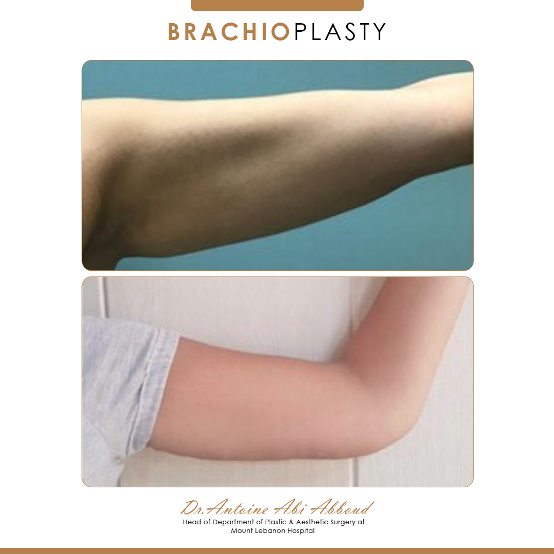 Arm Lift before and after — case 3