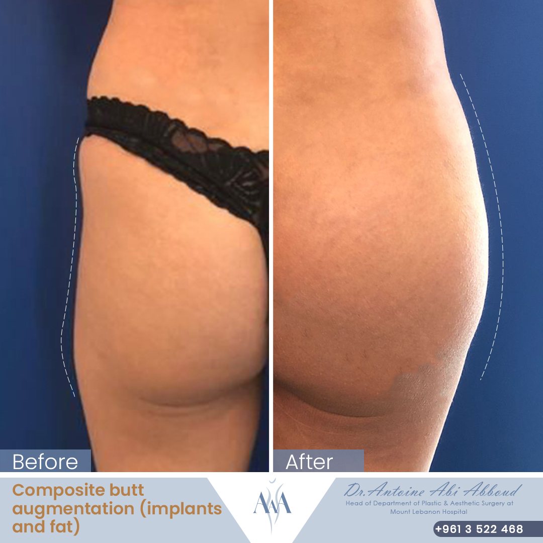 Butt Augmentation before and after — case 5