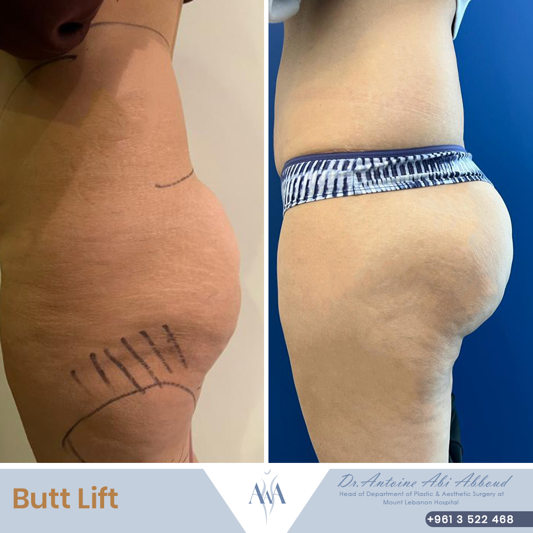 Butt Lift before and after — case 4