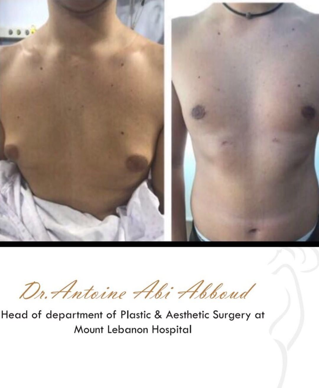 Gynecomastia before and after — case 1