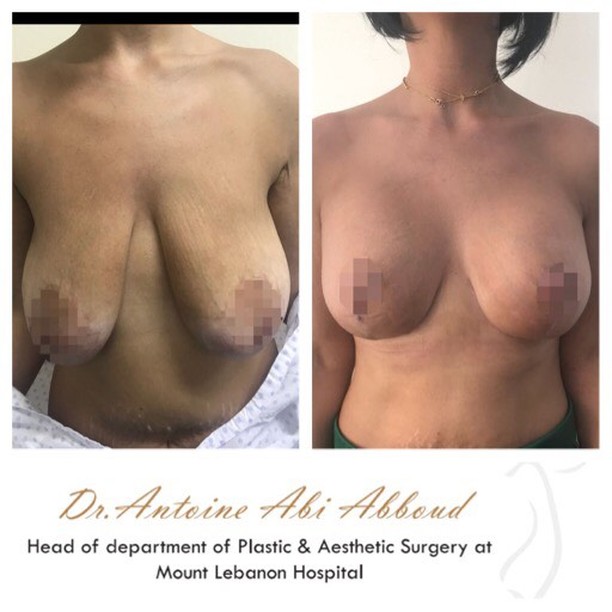 Mastopexy (Breast Lift) before and after — case 1