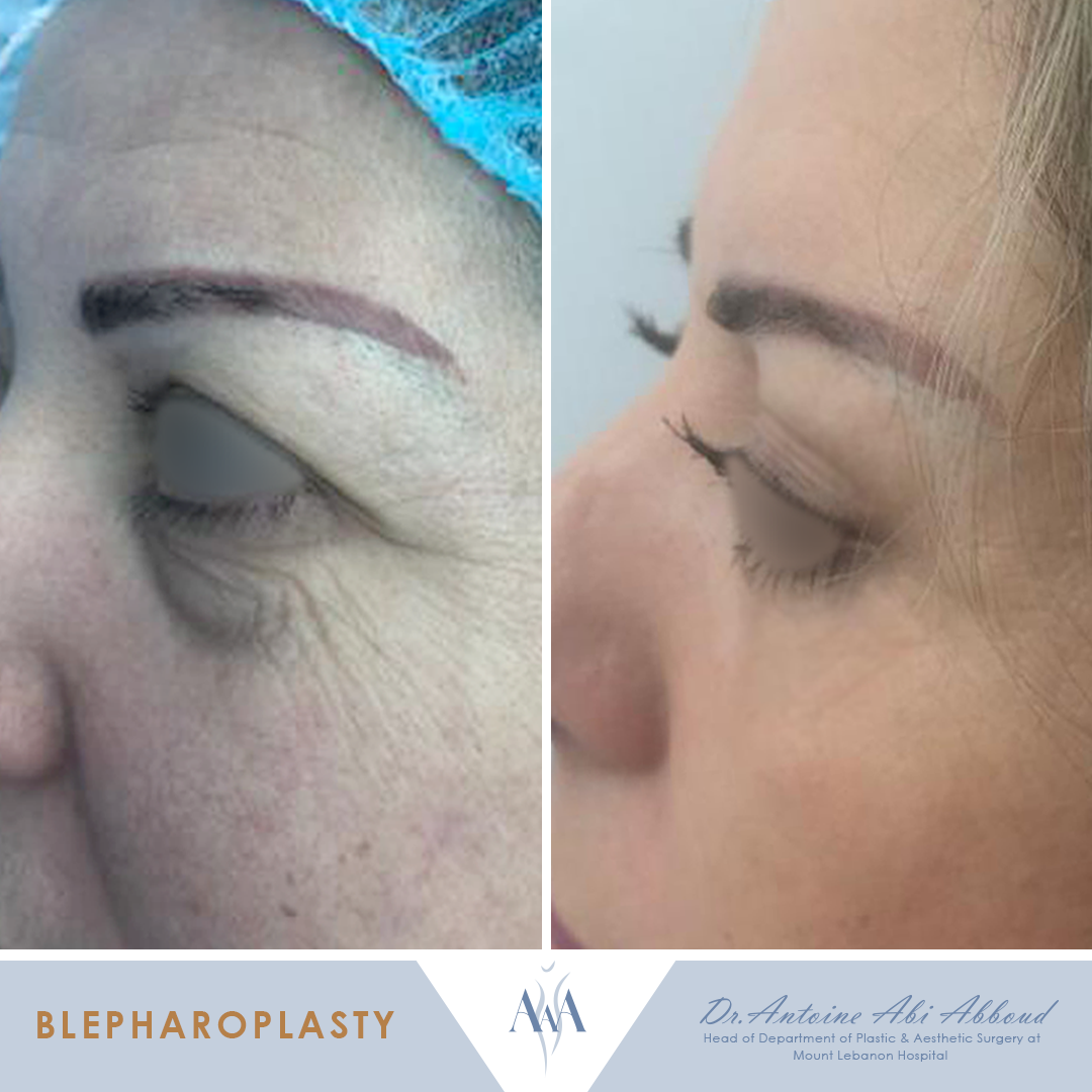 Blepharoplasty before and after — case 4