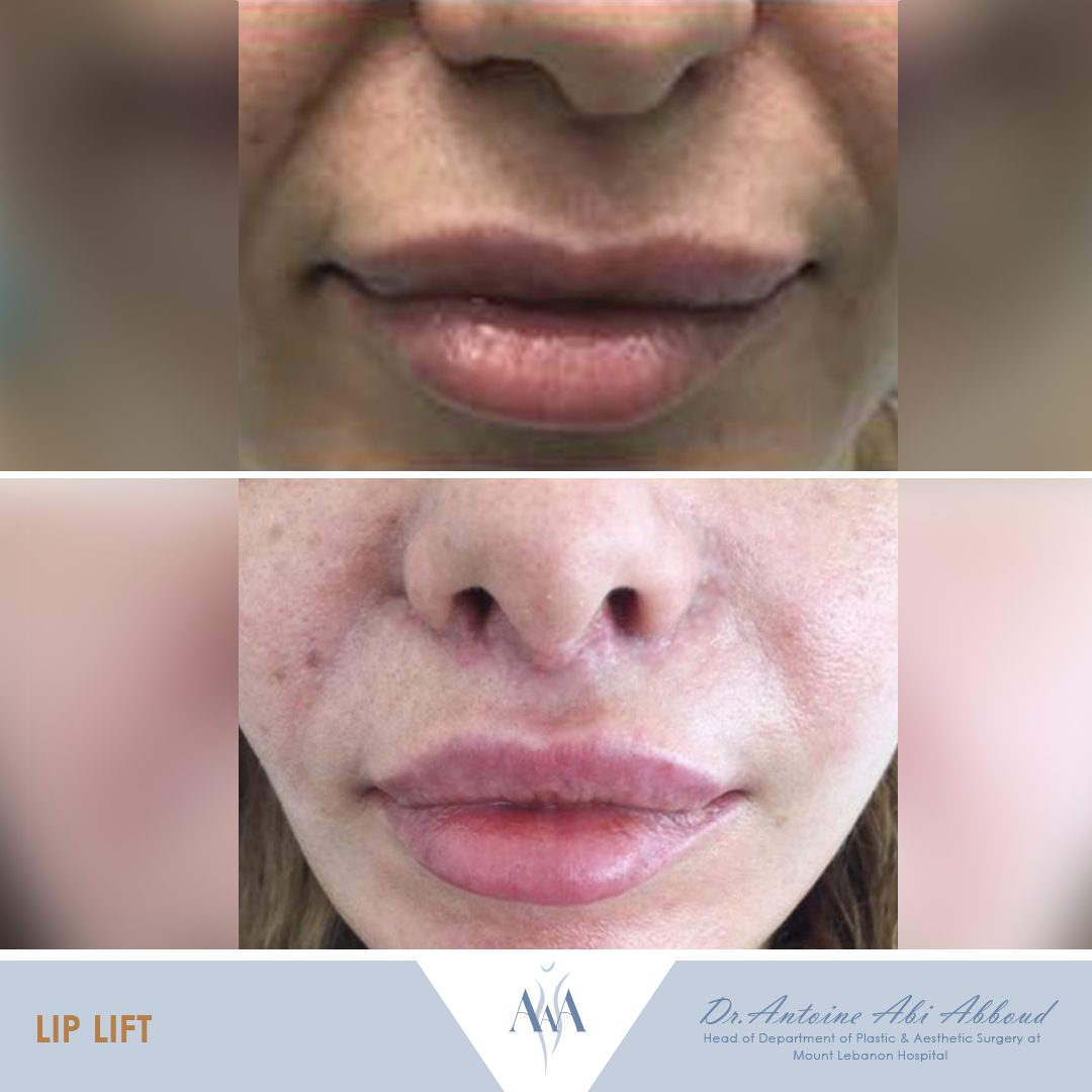 Lip Surgery before and after — case 3