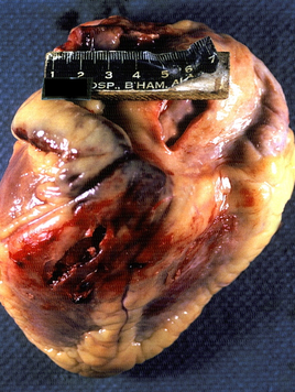 ¿Por qué el hombre es más propenso a que le rompan el corazón?