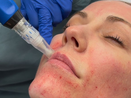 Microneedling in Scottsdale