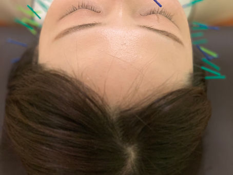 キレイになるには即効性のある鍼で...