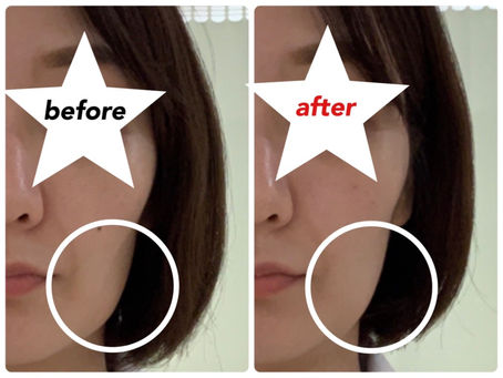 本日も美容鍼+マトリクスウェーブ