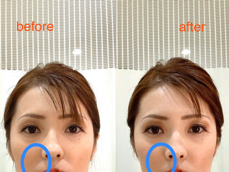 美顔鍼+マトリクスウェーブ