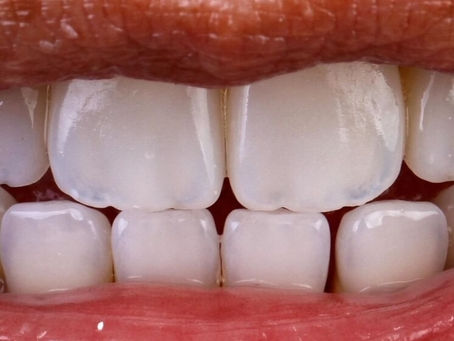 Mastering the Art of Aesthetics: Composite vs Porcelain Veneers: The Case for Composite Veneers