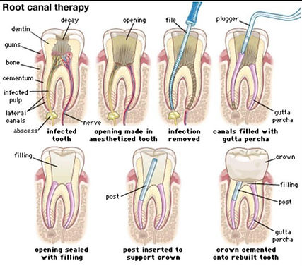 Root Canal graphic