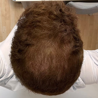5 Months After FUE Surgery