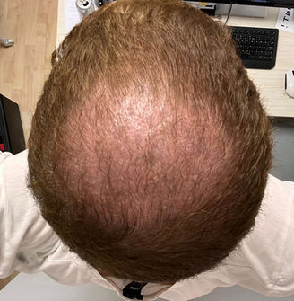 2 Months After FUE Surgery