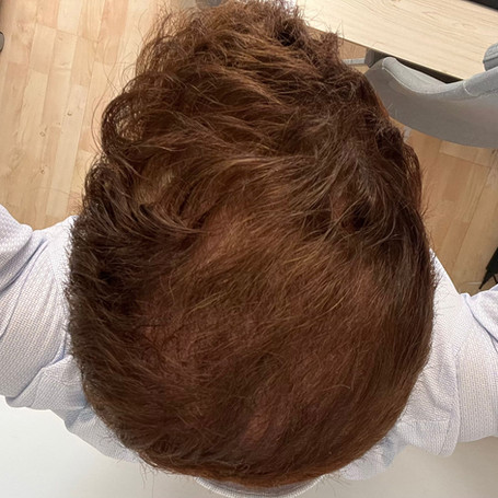 Hair Transplant After 6 Months
