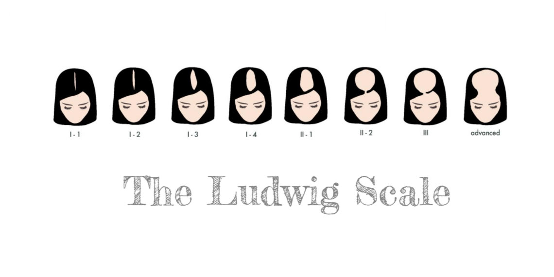 Ludwig Scale - Hair Loss in Women
