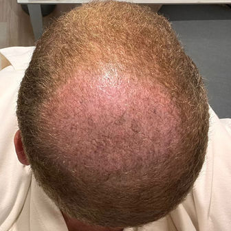 1 Month After FUE Surgery