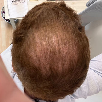 Hair Transplant 4 Months After Surgery