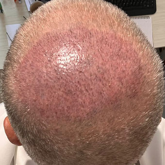 Hair Transplant 2 Weeks After Surgery