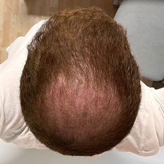 2 Months After FUE Surgery