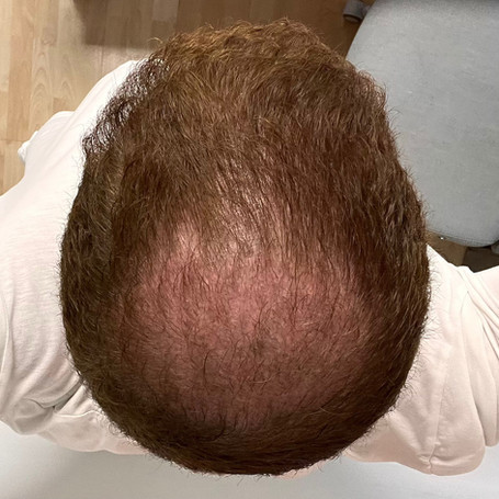 Hair Transplant After 3 Months