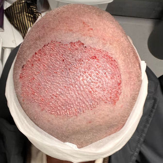 Immediately After FUE Surgery