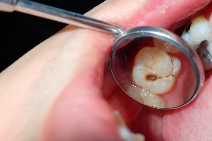 Dental Disease
