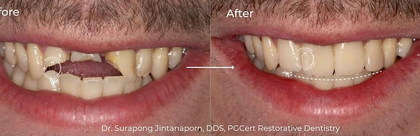 Smile makeover with ceramic crowns