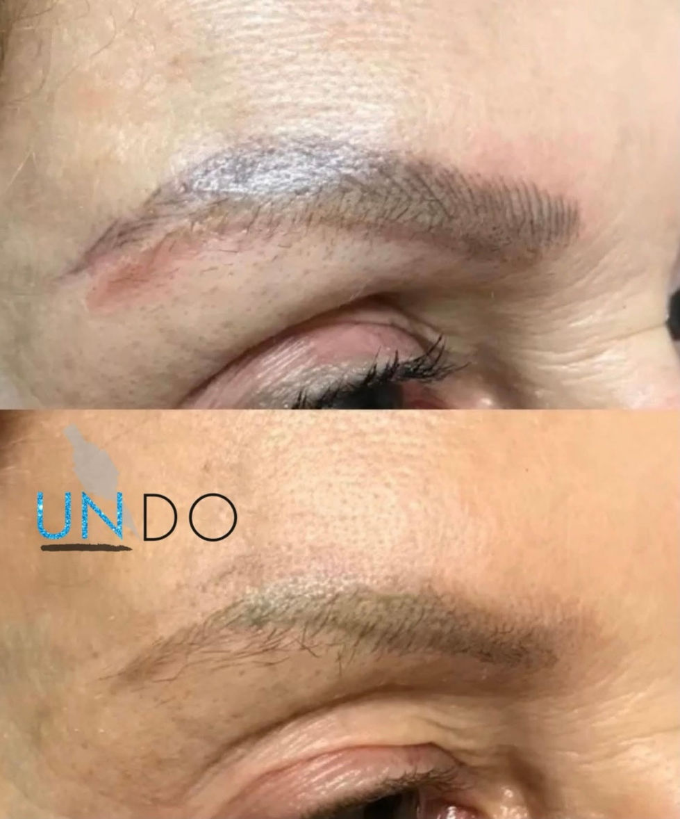 microblading tattoo removal