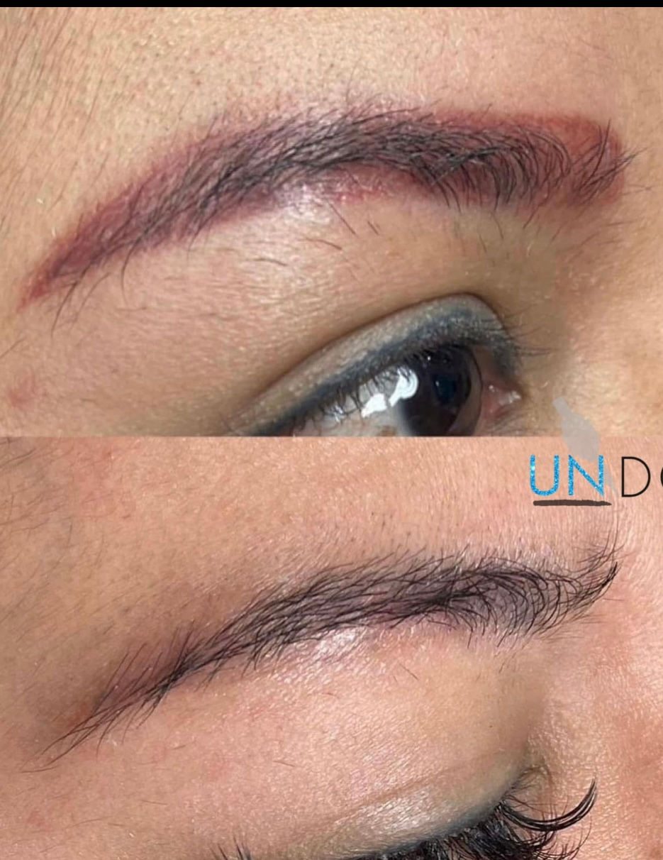 old eyebrow tattoo removal