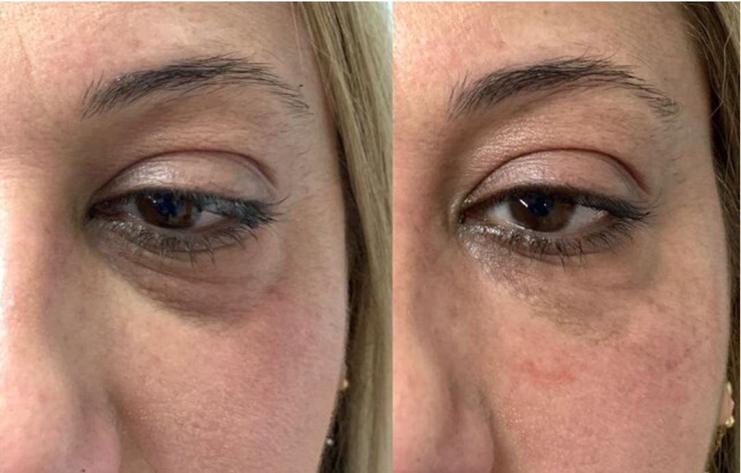 Resultado Fat4Beauty — pálpebras inferiores 10 meses