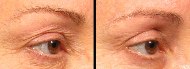 Ultraformer III | O Queridinho dos Famosos | Brasília