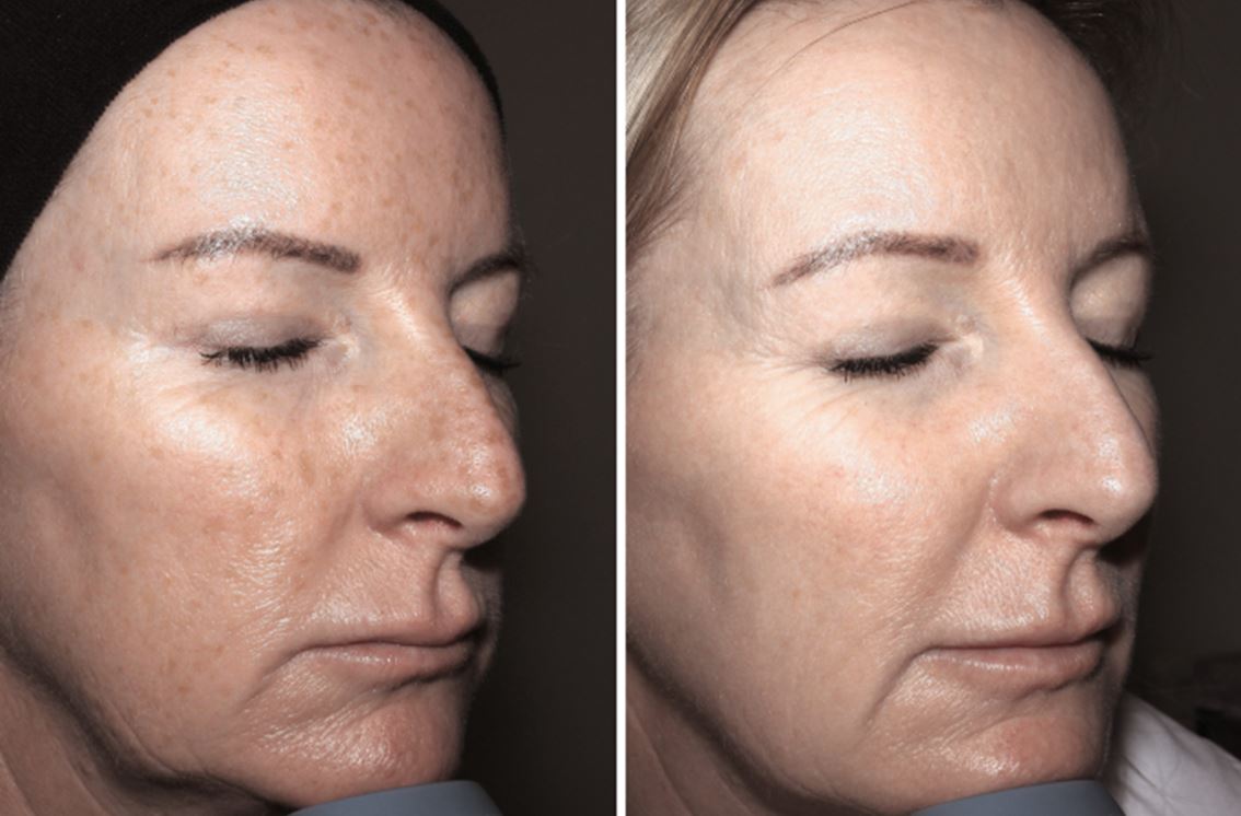 Resultado Fat4Beauty — face completa 6 meses