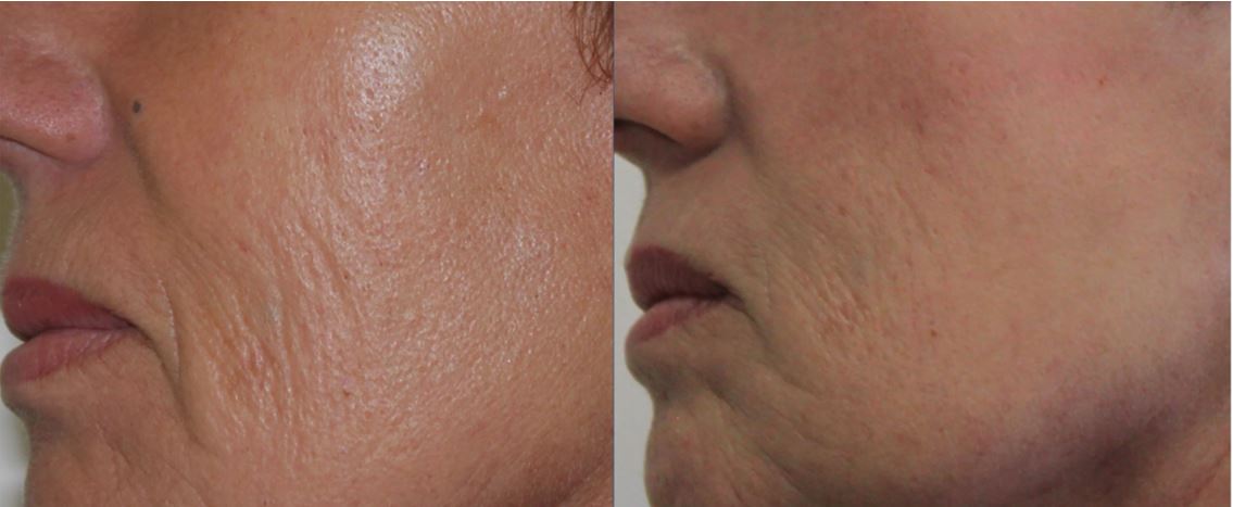 Resultado Fat4Beauty — rugas área bucal 12 meses