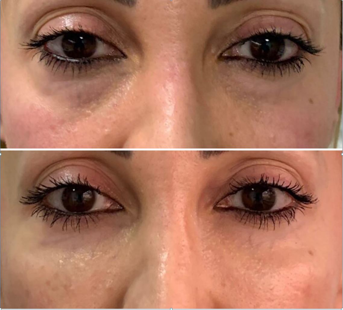 Resultado Fat4Beauty — pálpebras inferiores 14 meses