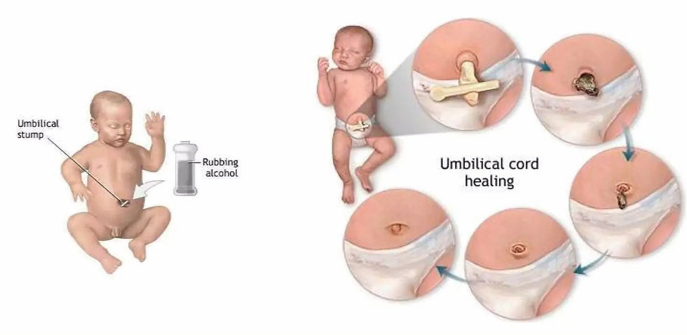 newborn's umbilical care